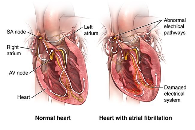 Understanding Atrial Fibrillation Blood Clots