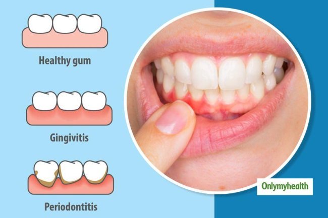 Gingivitis: How Our Gums Impact Our Teeth & Ways to Improve It