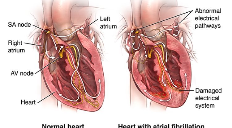 Understanding Atrial Fibrillation Blood Clots
