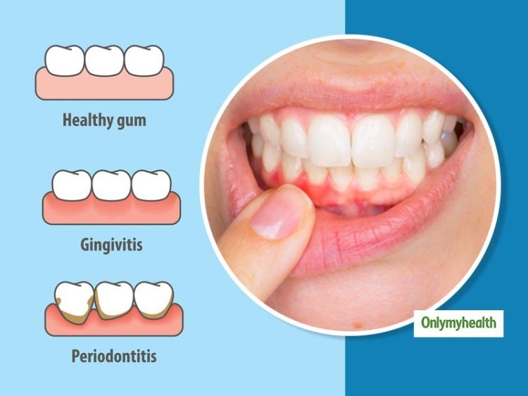 Gingivitis: How Our Gums Impact Our Teeth & Ways to Improve It