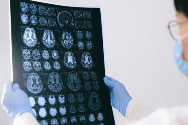 Novel Alzheimer's medication: US panel of experts approves Donanemab's FDA approval