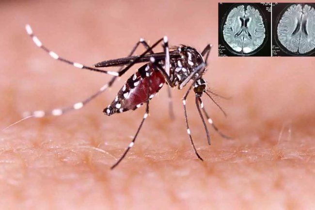 How dengue can impact the neurological system and brain