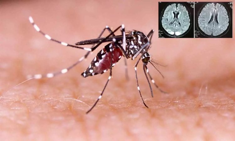 How dengue can impact the neurological system and brain